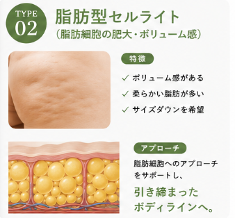 脂肪型セルライト