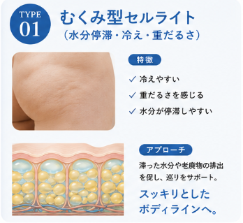 むくみ型セルライト